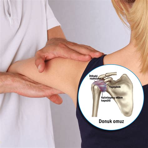 2. derece omuz ekleminin artrozu nasıl tedavi edilir